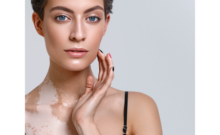 Как остановить течение витилиго и какие препараты работают эффективнее?